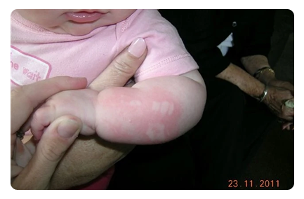 Rashes