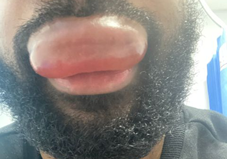 Allergy Diagnosis<br />
